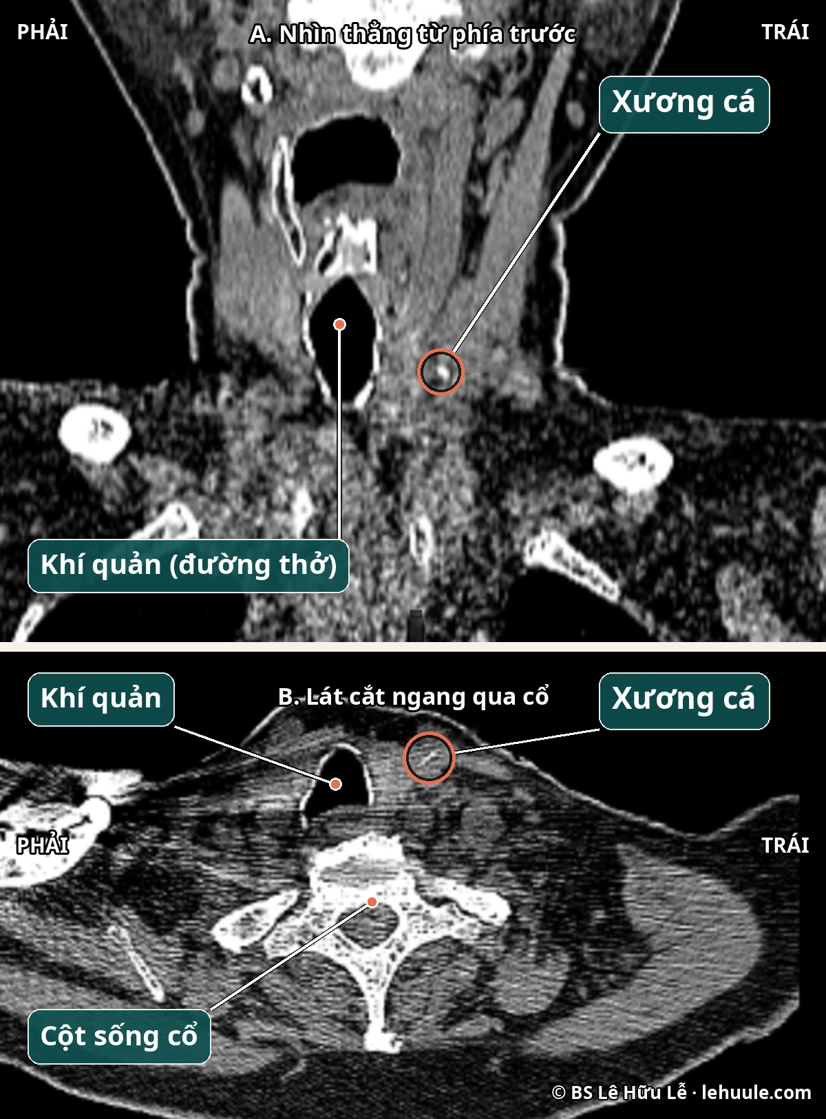 Ảnh CT cổ: xương cá đã xuyên ra ngoài thực quản, nằm trong mô cổ bên trái